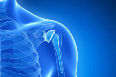 Shoulder Replacement