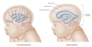 Hydrocephalus Diagram in Infants
