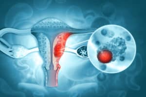 Texas Endometrial Cancer Lawyer