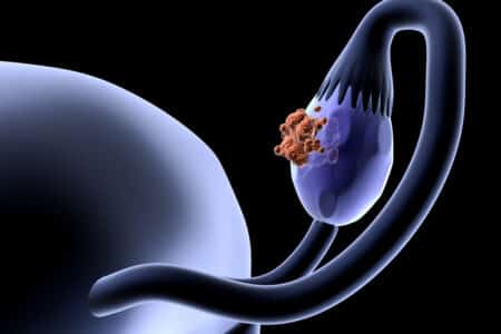 Texas Hair Relaxer Ovarian Cancer Lawyer