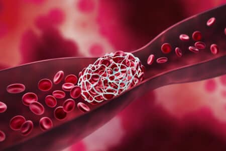 IVC Filter Lawsuit